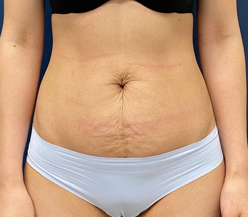 Tummy Tuck Before & After Image