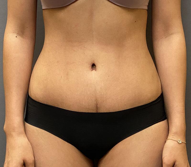 Tummy Tuck Before & After Image