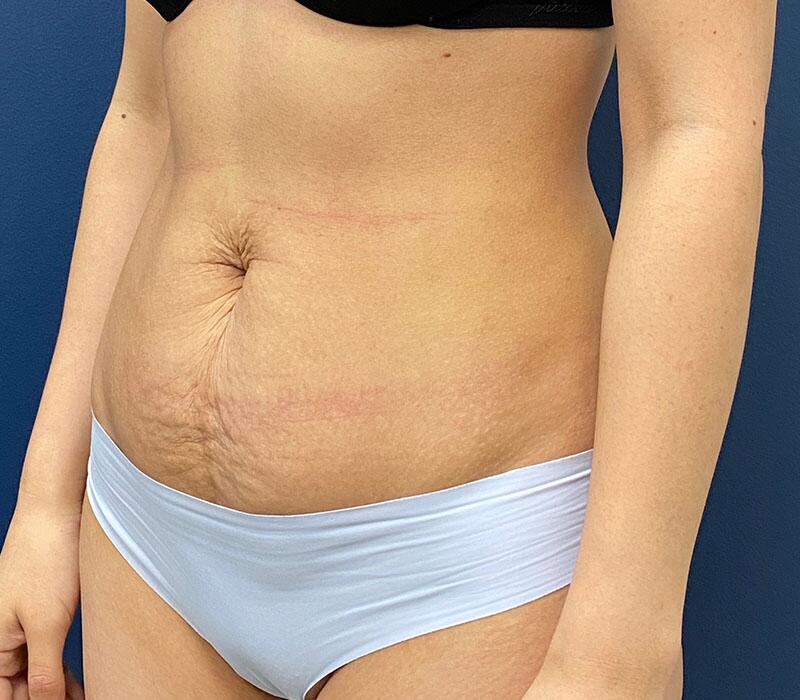 Tummy Tuck Before & After Image