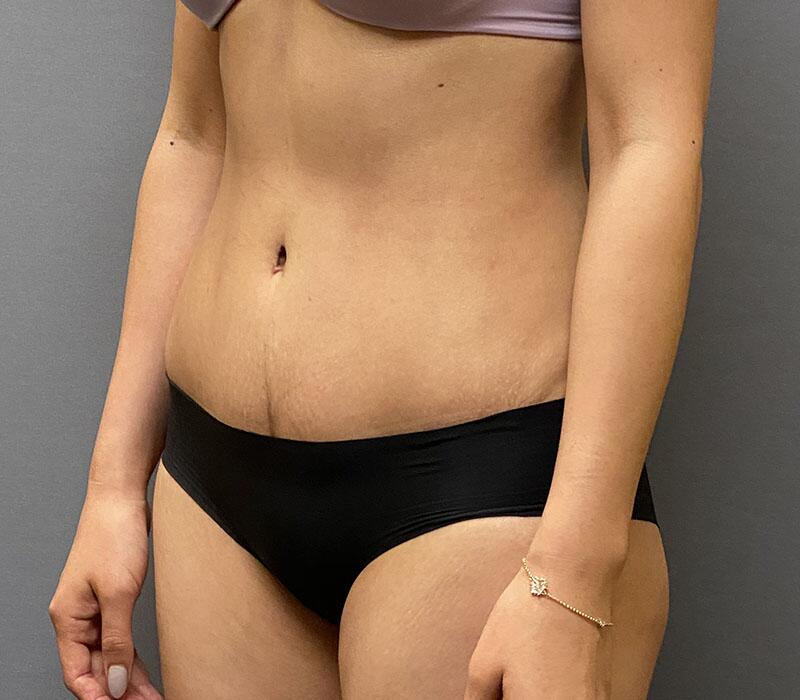 Tummy Tuck Before & After Image