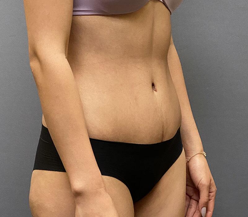 Tummy Tuck Before & After Image