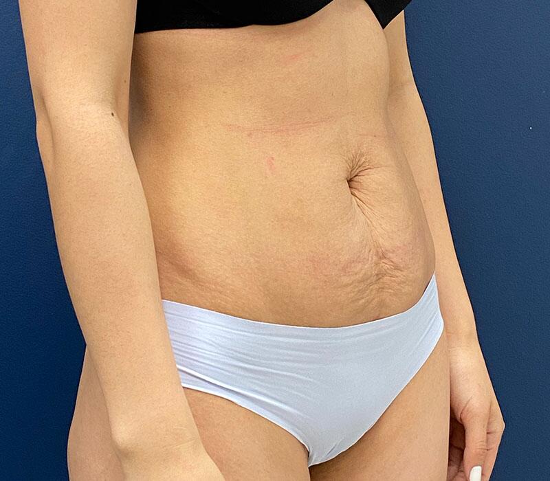 Tummy Tuck Before & After Image