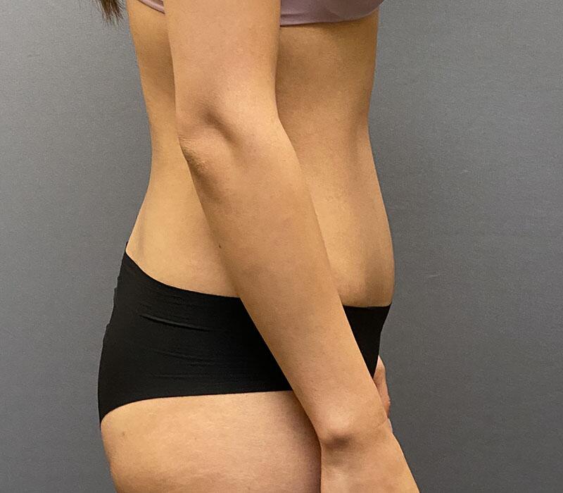 Tummy Tuck Before & After Image