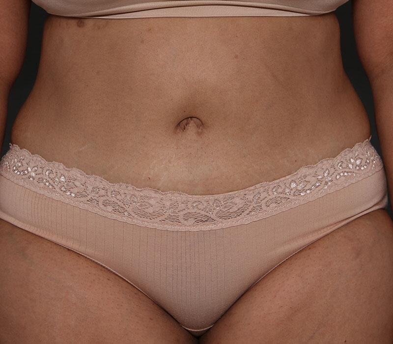 Tummy Tuck Before & After Image