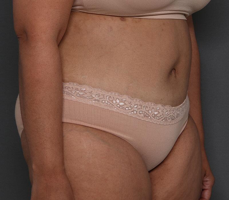 Tummy Tuck Before & After Image