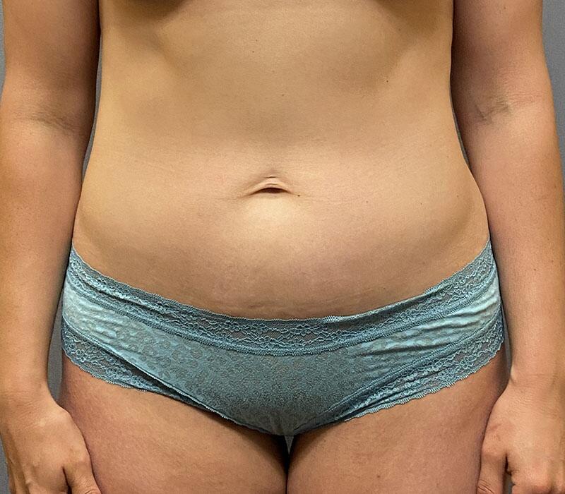 Tummy Tuck Before & After Image