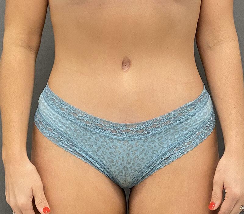 Tummy Tuck Before & After Image