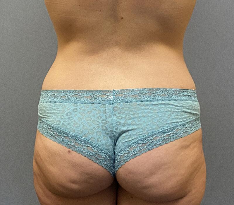 Tummy Tuck Before & After Image