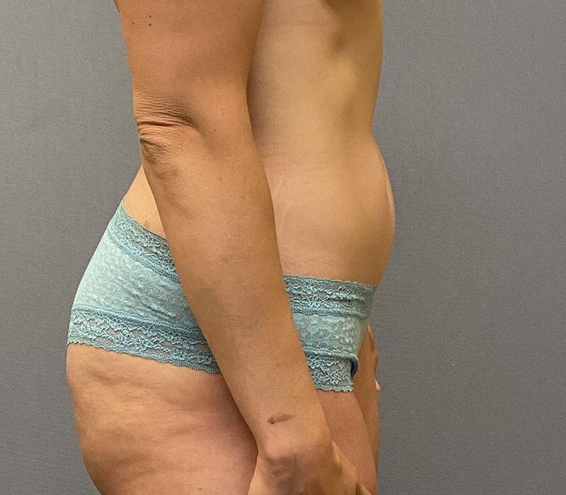 Tummy Tuck Before & After Image