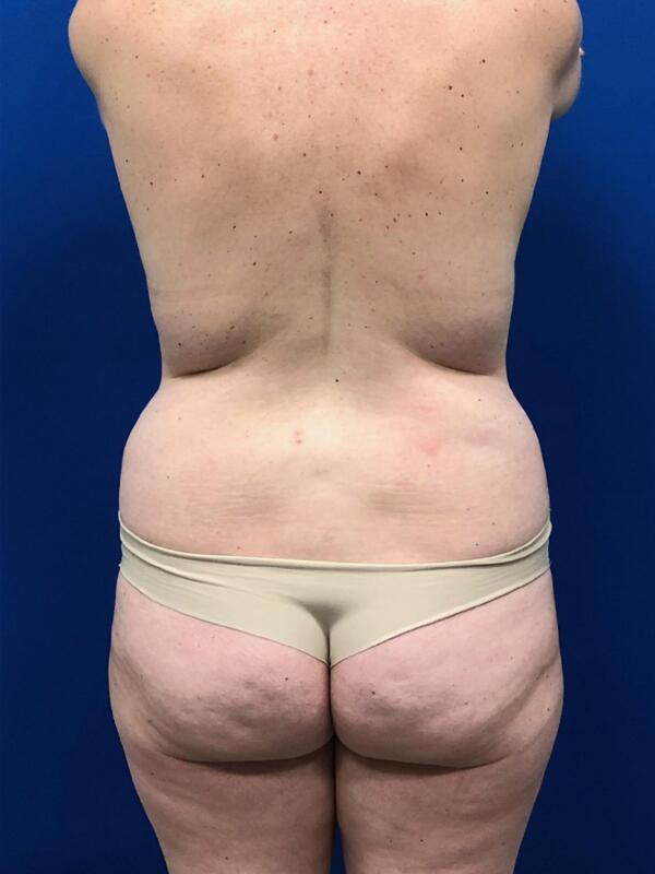 Brazilian Butt Lift  Before & After Image