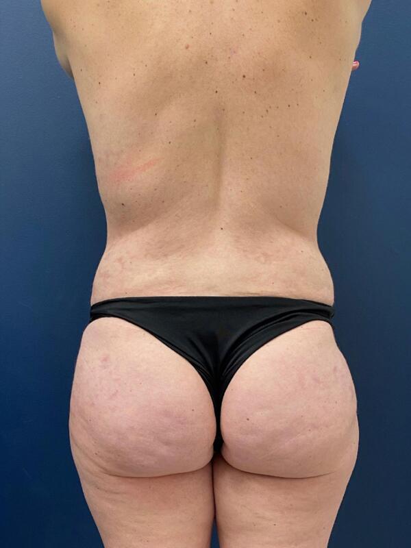 Brazilian Butt Lift  Before & After Image