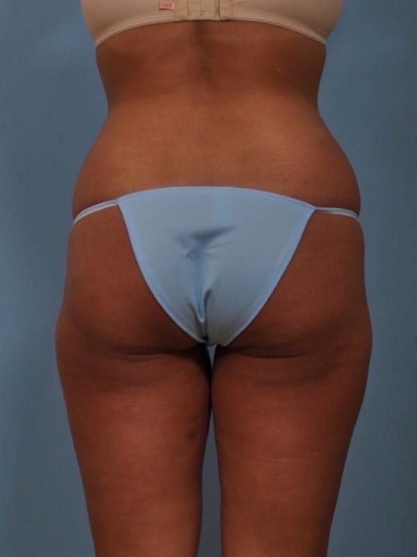 Brazilian Butt Lift  Before & After Image