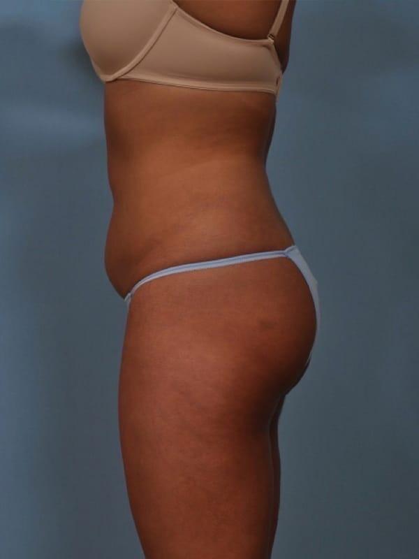 Brazilian Butt Lift  Before & After Image