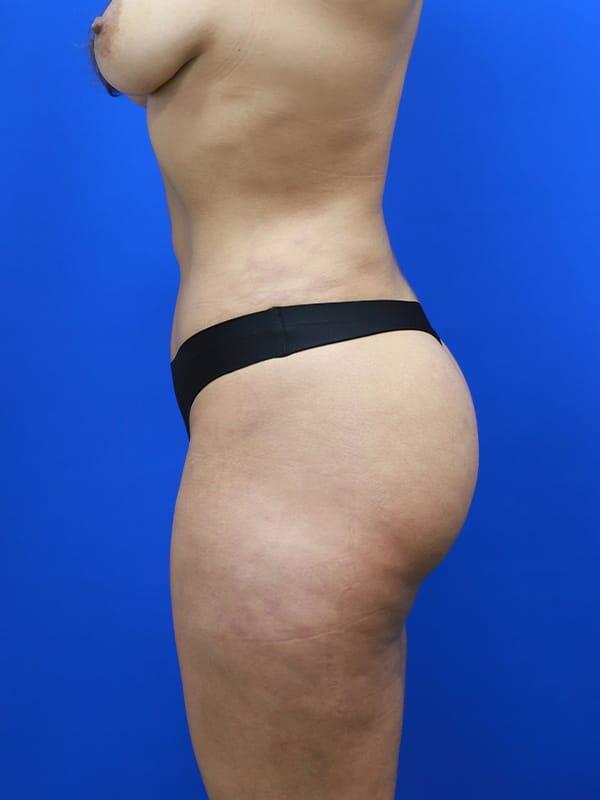 Brazilian Butt Lift  Before & After Image