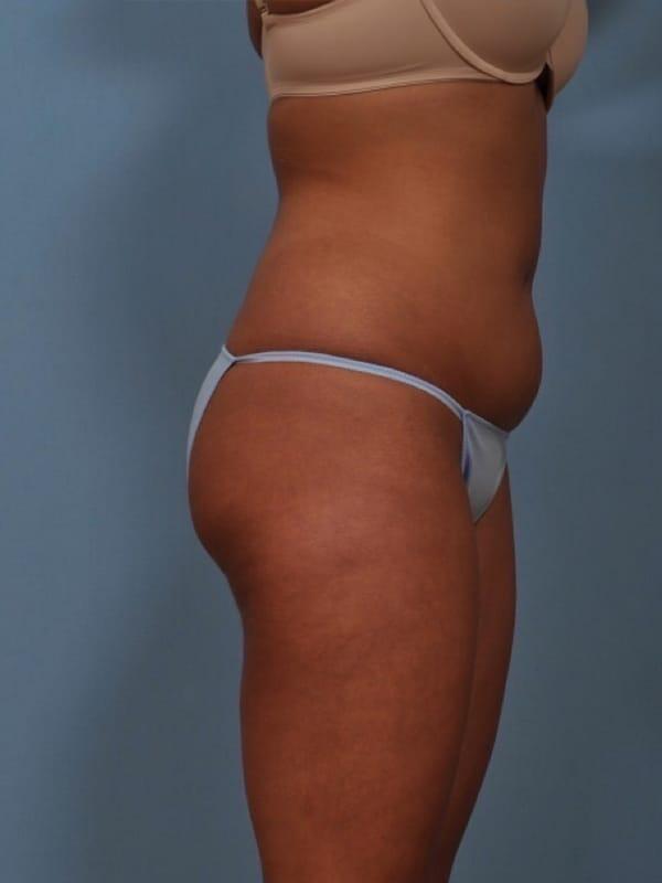 Brazilian Butt Lift  Before & After Image