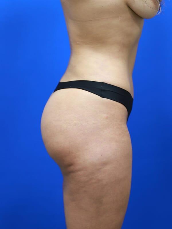 Brazilian Butt Lift  Before & After Image