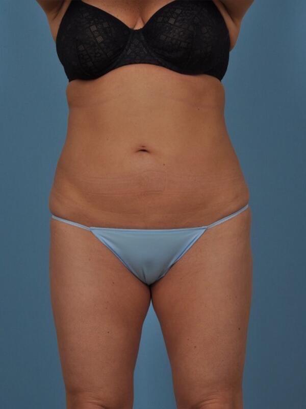 Liposuction Before & After Image