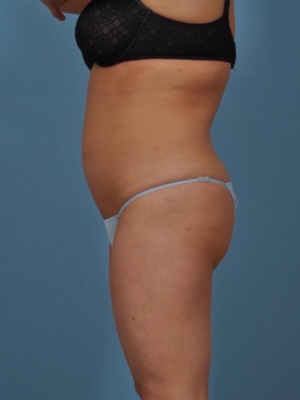 Liposuction Before & After Image