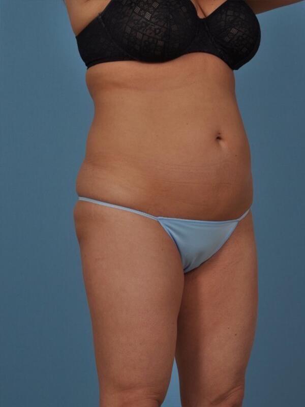 Liposuction Before & After Image