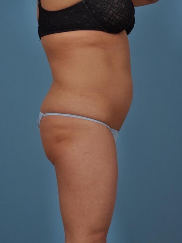 Liposuction Before & After Image