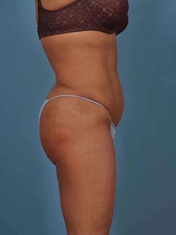 Liposuction Before & After Image