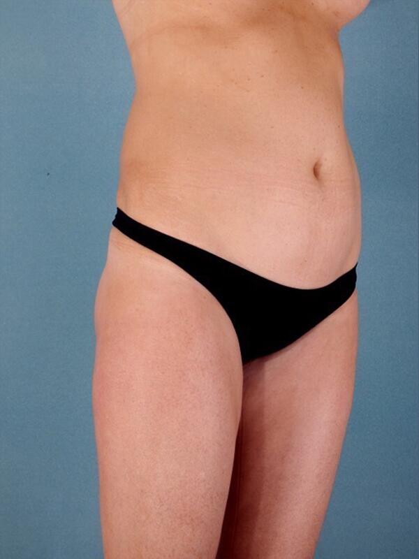 Liposuction Before & After Image