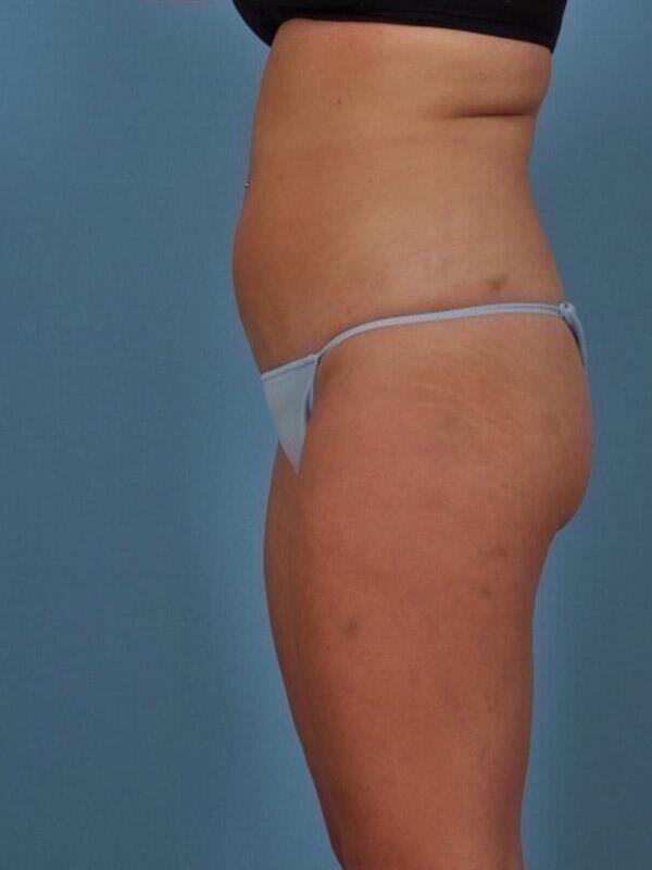 Liposuction Before & After Image