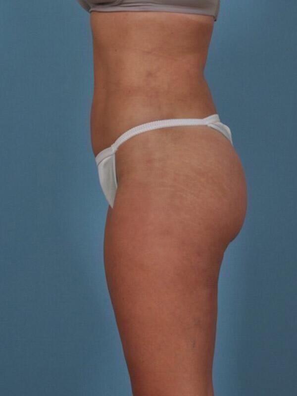 Liposuction Before & After Image