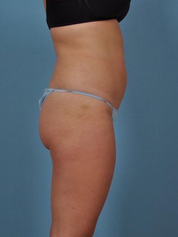 Liposuction Before & After Image