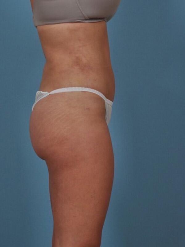 Liposuction Before & After Image