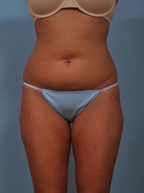 Liposuction Before & After Image