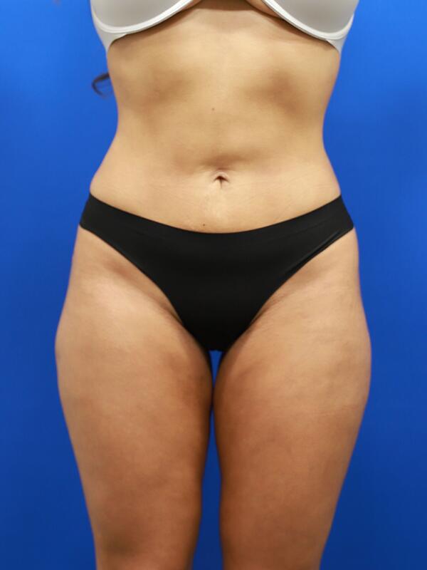 Liposuction Before & After Image