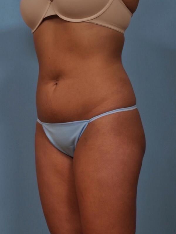 Liposuction Before & After Image