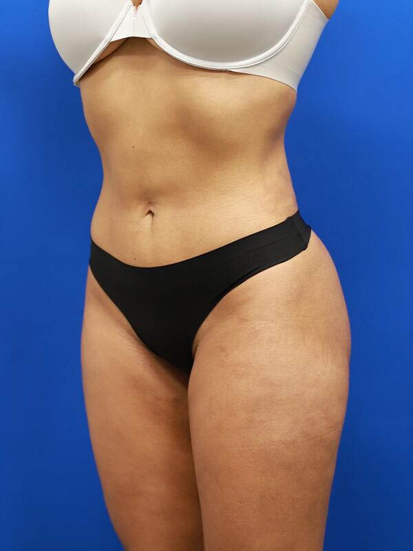 Liposuction Before & After Image