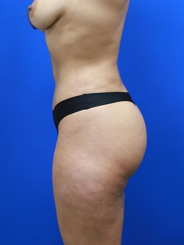 Liposuction Before & After Image