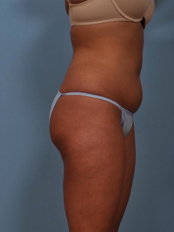 Liposuction Before & After Image