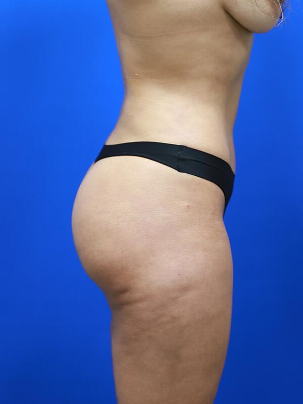 Liposuction Before & After Image