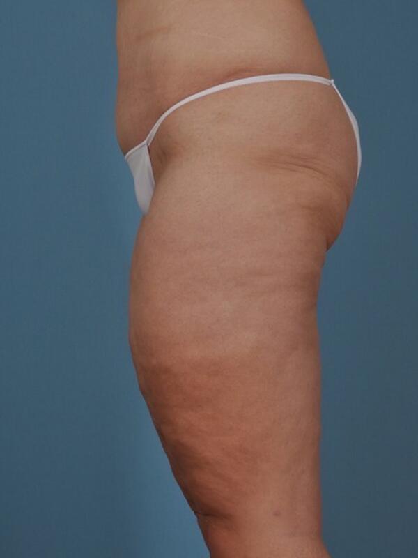 Thigh Lift Before & After Image