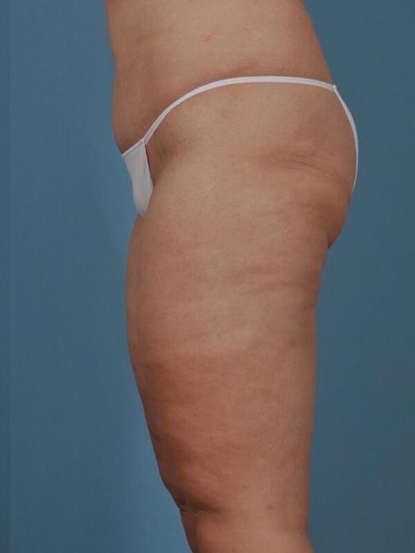 Thigh Lift Before & After Image