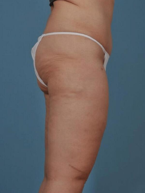 Thigh Lift Before & After Image