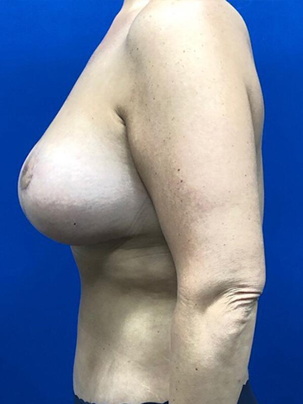 Breast Augmentation With Lift Before & After Image