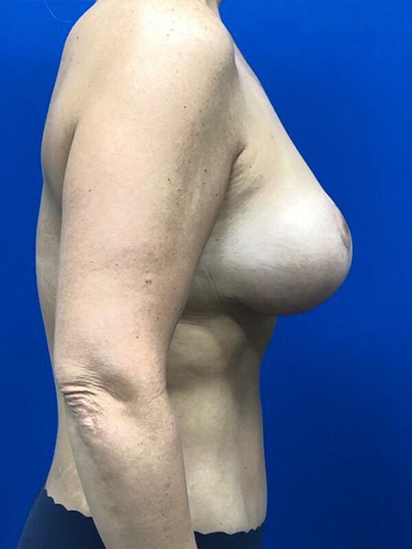 Breast Augmentation With Lift Before & After Image