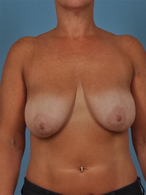 Breast Augmentation With Lift Before & After Image