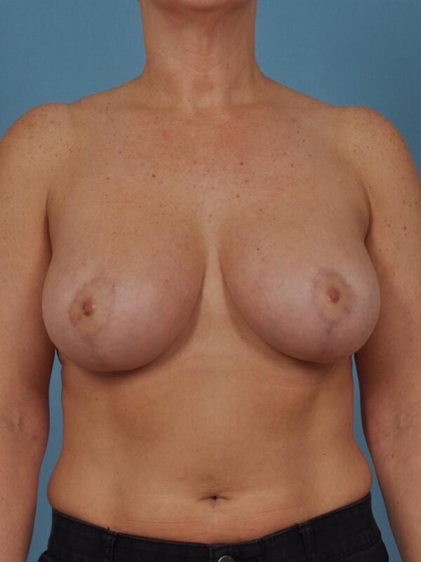 Breast Augmentation With Lift Before & After Image