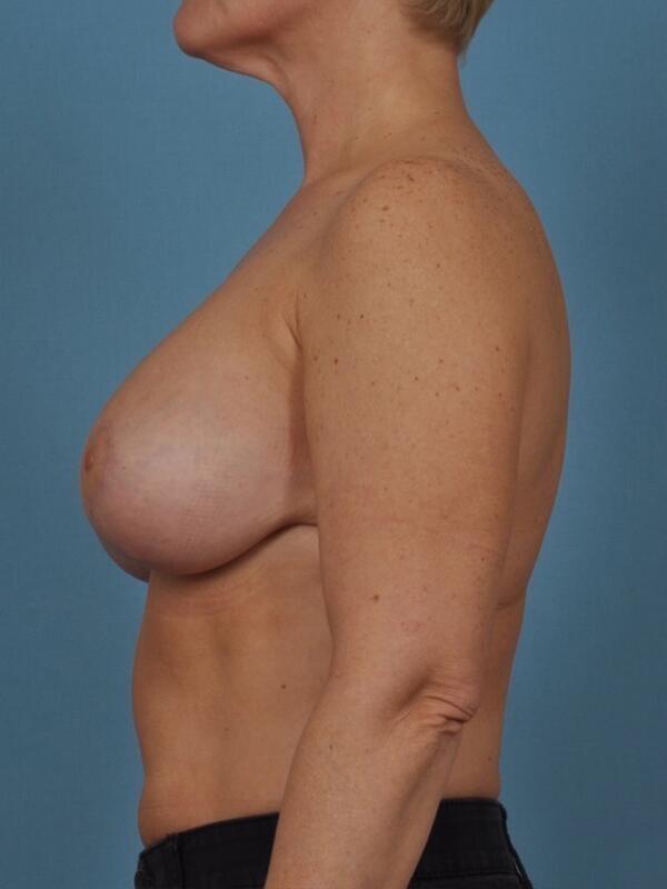 Breast Augmentation With Lift Before & After Image