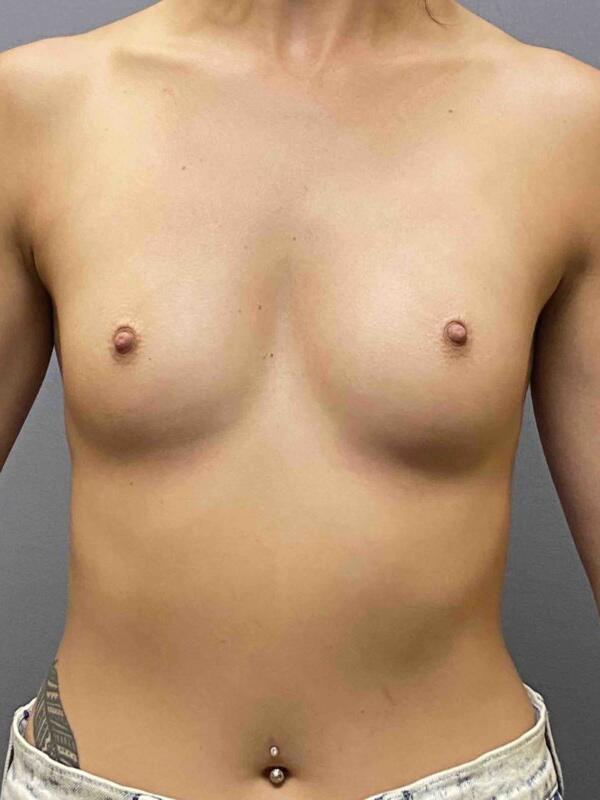 Breast Augmentation Before & After Image