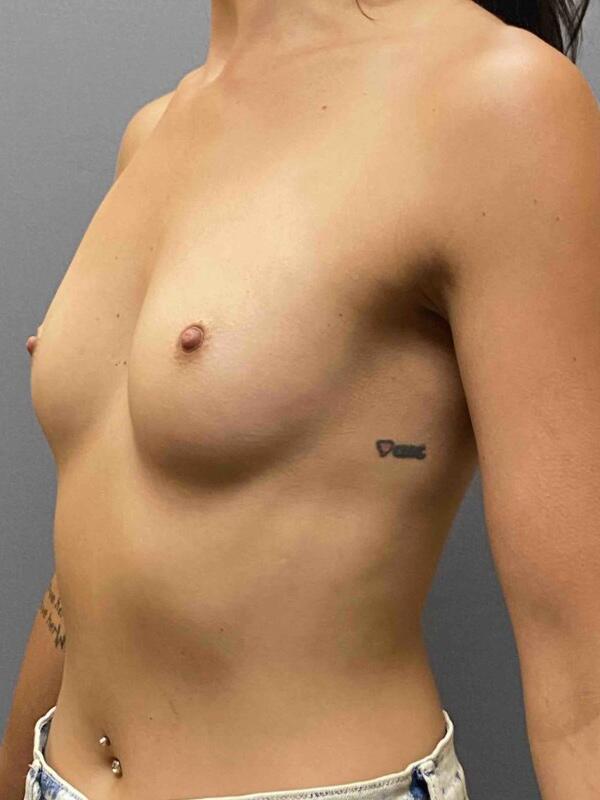 Breast Augmentation Before & After Image