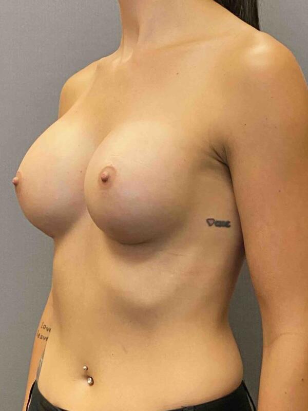 Breast Augmentation Before & After Image