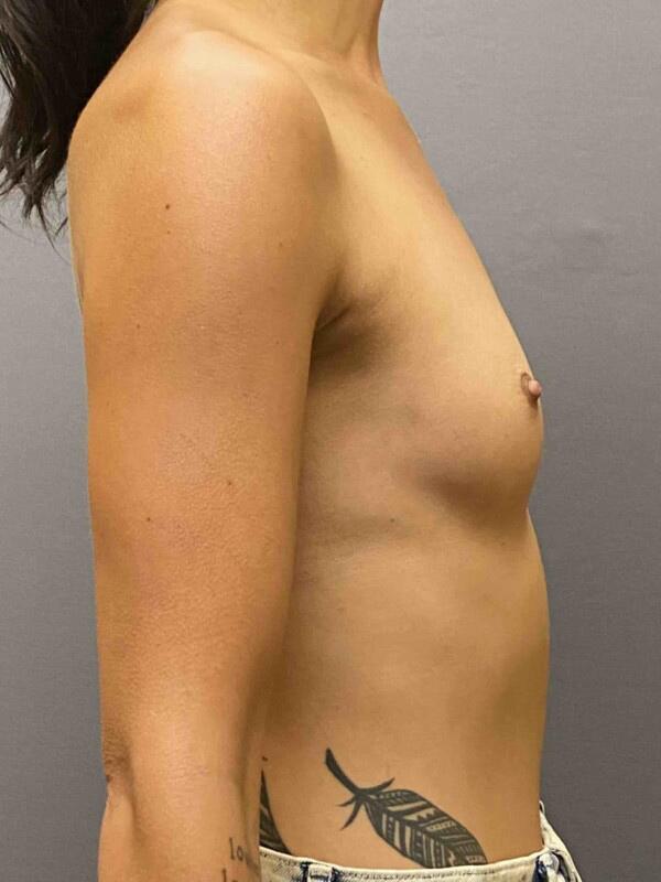 Breast Augmentation Before & After Image