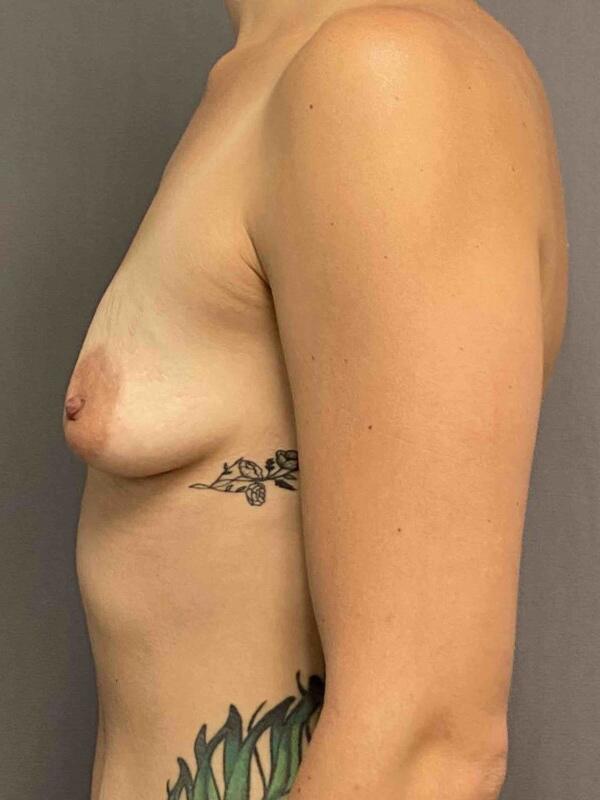 Breast Augmentation Before & After Image